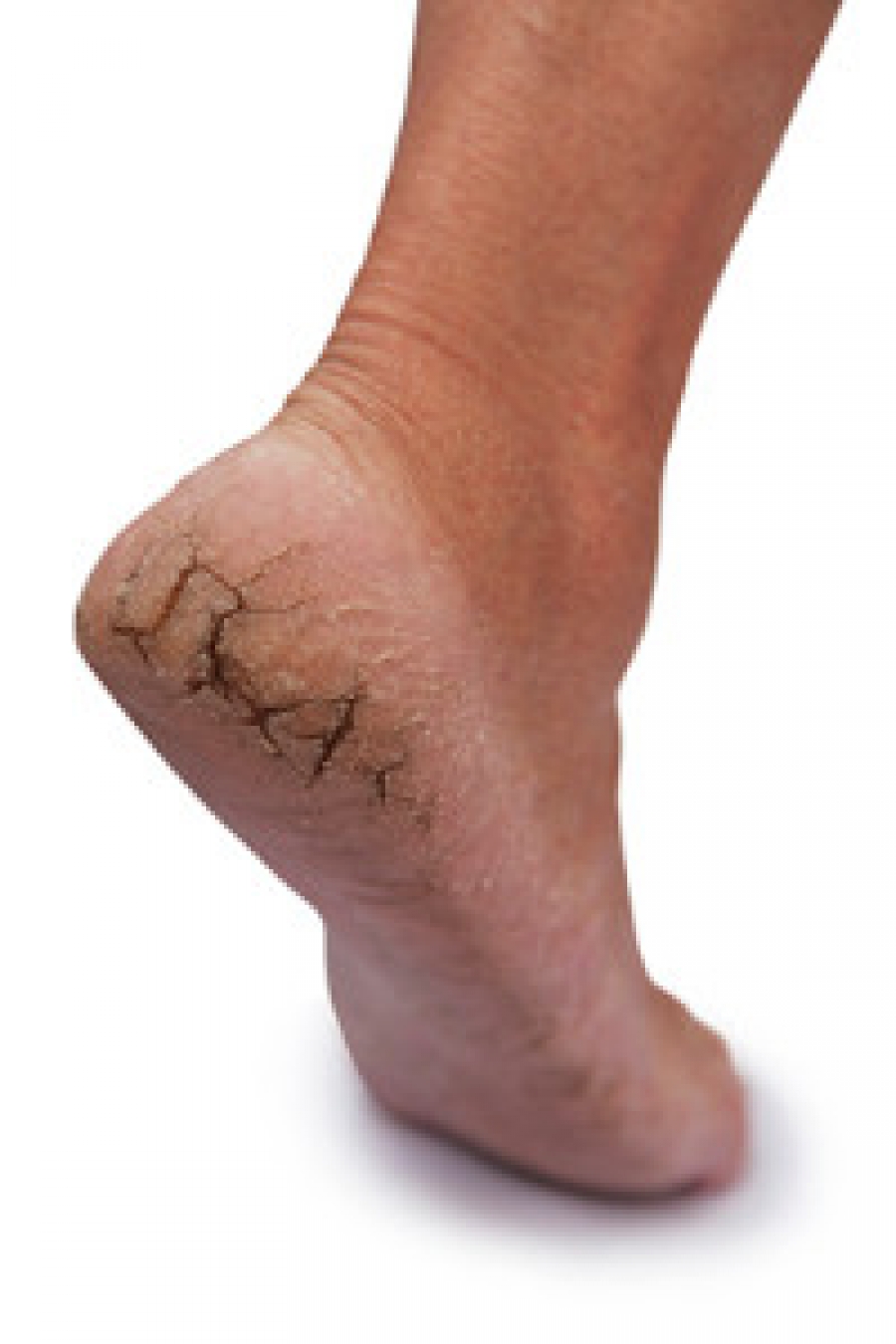 Cracked Heels and Heel Fissures | Foot & Ankle