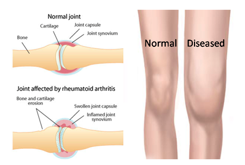 Swelling перевод. Joint stiffness.