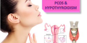 CO-EXISTENCE OF PCOS AND HYPOTHYROIDISM