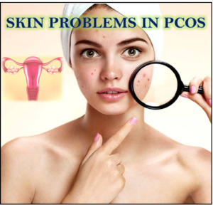 SKIN PROBLEMS IN PCOS