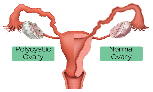 What is Polycystic Ovary Syndrome (PCOS)?