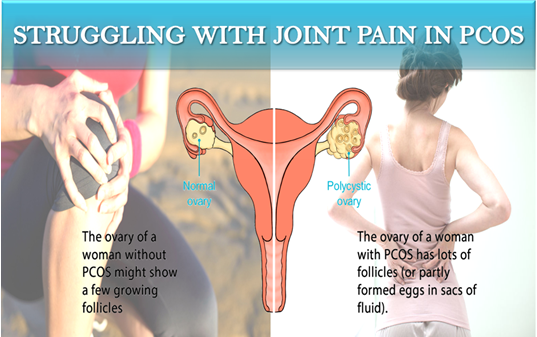 STRUGGLING WITH JOINT PAIN IN PCOS