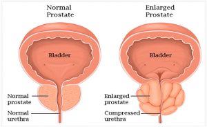 enlarge prostate | prostate gland enlargement treatment ayurvedic