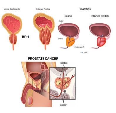 Prostate conditions