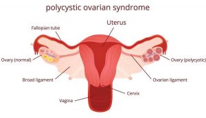 Polycystic Ovary syndrome Furocyst