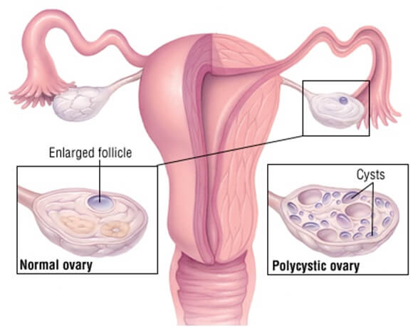 polycystic ovary - furocyst